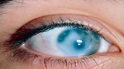 Simptomele bolii oculare retiniene