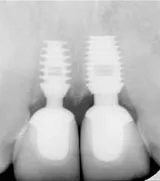 A fogászati ​​implantátumok véleménye, vélemény fogászati ​​implantátumokat, fogászati ​​implantátumokat véleménye, fogászati ​​implantátumok