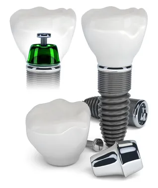 A fogászati ​​implantátumok véleménye, vélemény fogászati ​​implantátumokat, fogászati ​​implantátumokat véleménye, fogászati ​​implantátumok