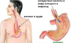 Киселини и парене в гърлото - причини като да се отърве от лечението