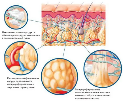 Hogyan lehet megszabadulni a cellulitisz otthon 1