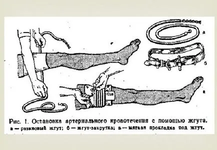 Как да спрем артериално кървене основните методи