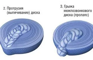 6 вида foraminal диск издатината