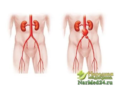 Аневризма симптоми, локализиране на болестта, своевременно лечение
