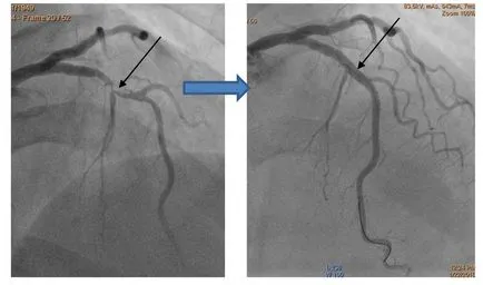 Angioplasztika és stent beültetést koszorúerek a szív, LLC „Medservice” - vezetője Medicine