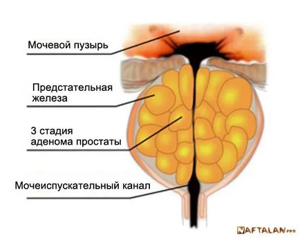 Tratamentul BPH ulei Naphthalan si prevenirea adenomului de prostată la moteluri