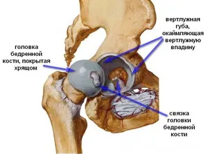 necroza avasculară a capului articulației șoldului a consecințelor și tratamentul bolii