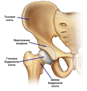 necroza avasculară a capului articulației șoldului a consecințelor și tratamentul bolii