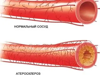 Атеросклерозата Лечение чесън (рецепти на традиционната медицина)