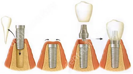 A bazális implantáció, amikor a hátsó fogak helyreállítása