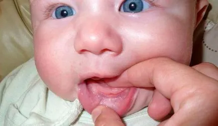 Fehér foltok a fogíny csecsemők okoz, kezelés