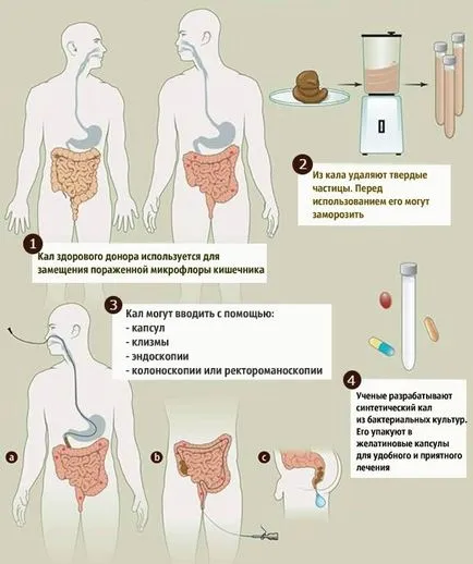 Какво е фекална трансплантация и защо тя се използва