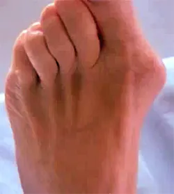 Деформацията на големия пръст на крака