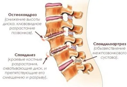 Деформирайки остеохондроза причини и лечения