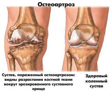 Deformáló osteoarthritis és degeneratív betegség lemez kezelést otthon