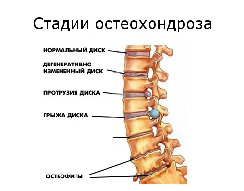 Deformând osteoartrita si tratament boli degenerative de disc la domiciliu