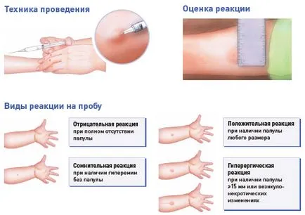 Diaskintest - Evaluare - chudetstvo