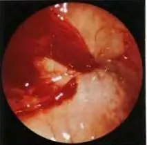 Diagnosticul endoscopica a sinusurilor paranazale