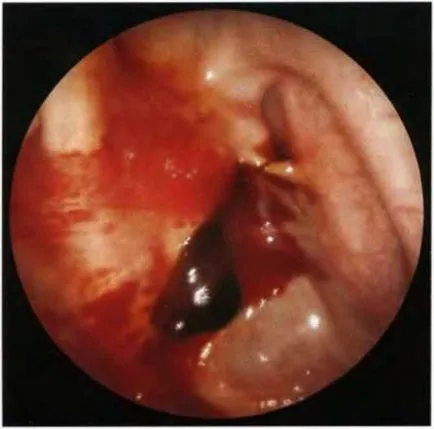 Diagnosticul endoscopica a sinusurilor paranazale