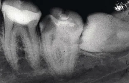 Üszkös pulpitis, krónikus fekélyes hatások, a kezelés