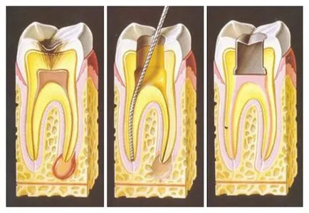 Üszkös pulpitis, krónikus fekélyes hatások, a kezelés