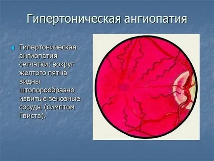 Хипертонична ретината ангиопатия