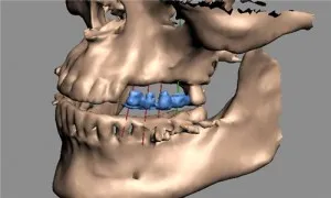 A fogászati ​​implantátumok 3d (3-dimenziós eh implantátum tervezés)