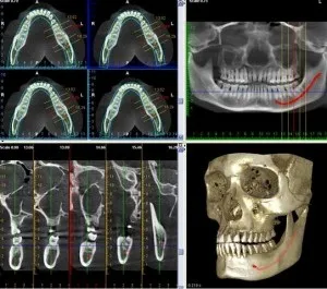 A fogászati ​​implantátumok 3d (3-dimenziós eh implantátum tervezés)