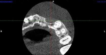 Tratamentul Implant în zona estetică (dinți 21, 22) - implantologiei - știri și