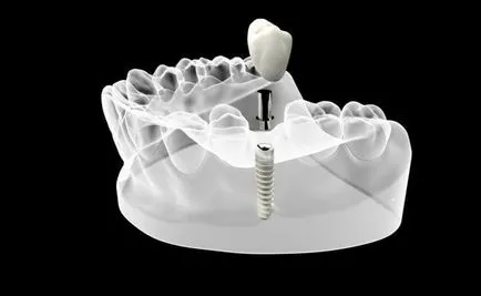 Az implantátumok a hátsó fogak - mit érdemes tenni