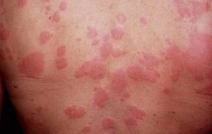 Idiopathiás urticaria - Tünetek és okok, hogyan csalánkiütés kezelésére