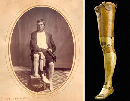Érdekes részleteket a történelem protézisek