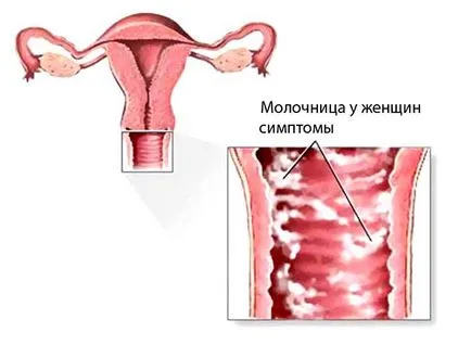 Как за лечение на гъбична инфекция при жените - причини, лечение