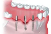 Ca o singură etapă de implantare se efectuează