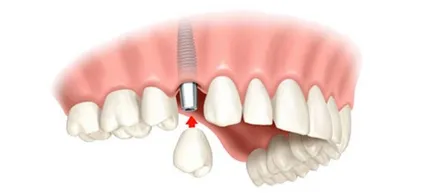 Ca o singură etapă de implantare se efectuează