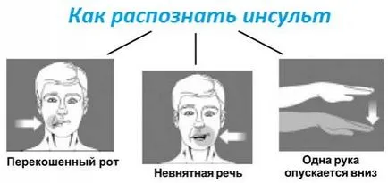 Cum de a recunoaște un accident vascular cerebral într-un prim ajutor uman