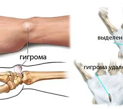 Как да се излекува без операция hygroma - Съвети за жени Online