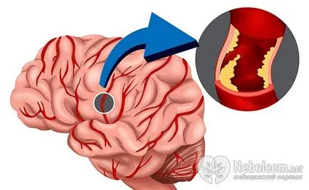 Hogyan ismerjük fel a stroke