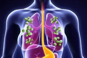 Candidoza simptome pulmonare, cauze si tratament