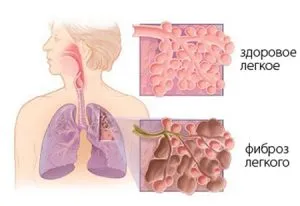 Candidoza simptome pulmonare, cauze si tratament