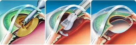 Chirurgia cataractei si reabilitare - linii directoare pentru restaurare