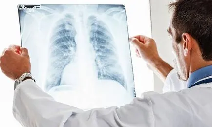 Candidoza simptome pulmonare, cauze si tratament