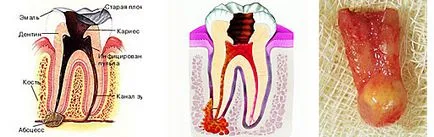 simptome Chist dentare, fotografie, tratament