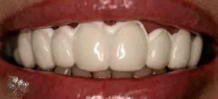 Конусният дефект причинява зъб пълнене на лечение, профилактика