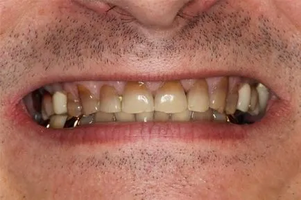 Конусният дефект причинява зъб пълнене на лечение, профилактика