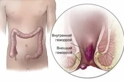 Castan de la lumânările de tratament hemoroizi si tinctura