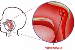 Лечение на аденоиди при деца народни средства