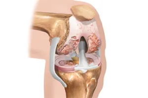 Tratamentul osteoartritei a genunchiului 3 grade