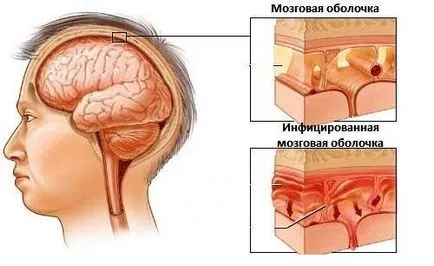 Tratamentul de atrofie a nervului optic pentru a îmbunătăți alimentarea cu sânge