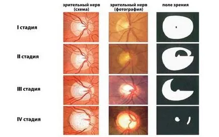 Kezelése sorvadás a látóideg, hogy javítsa a vérellátás